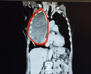 Immagine radiografica del sarcoma